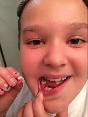 Kariss-lost-tooth-molar-sept-2014