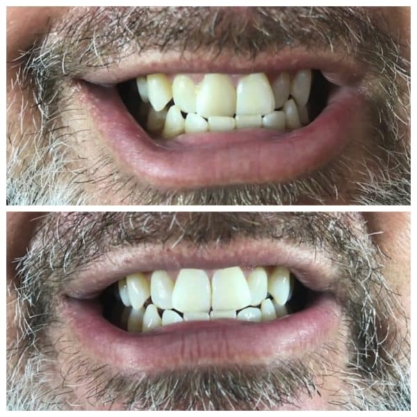 Rick Before-After stacked