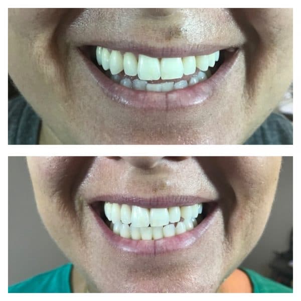 Sami Smile Brilliant Before After Teeth Whitening